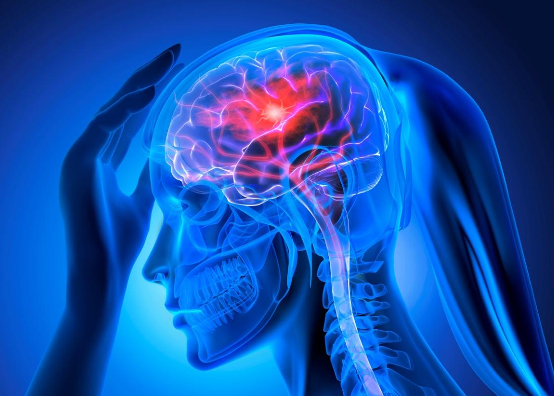 Røntgenbilde av kvinnehode med hjerneslag
