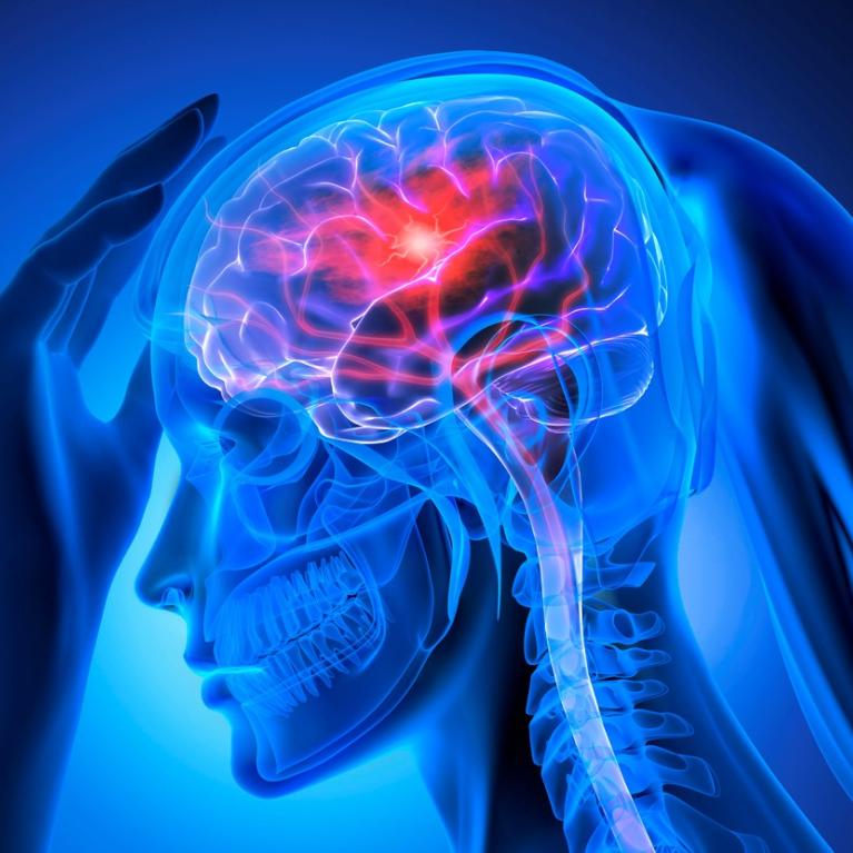 Røntgenbilde av kvinnehode med hjerneslag